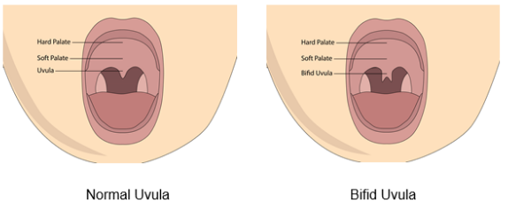 Understanding the Types of Cleft Palate and Their Treatment