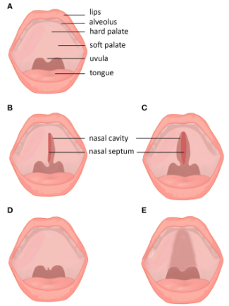 Understanding the Types of Cleft Palate and Their Treatment