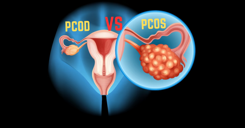 PCOD vs PCOS