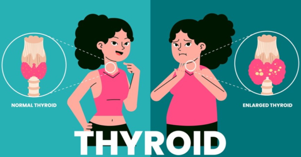 The Surprising Connection Between Thyroid Stimulating Hormone and Weight Loss