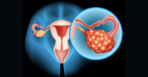 Myths about Adrenal PCOS You Need to Stop Believing