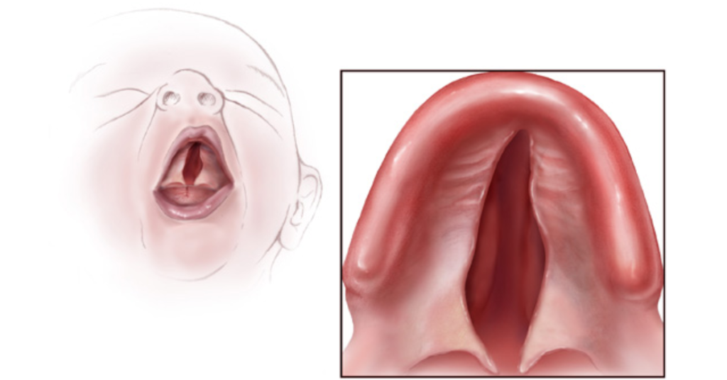 Understanding the Types of Cleft Palate and Their Treatment