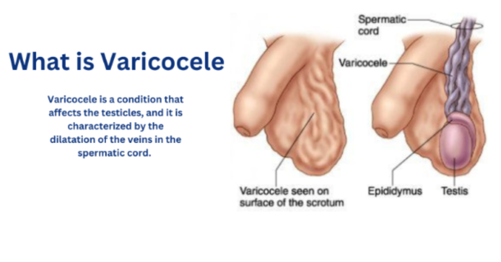 How Varicocele Impacts Fertility and What You Can Do About It?