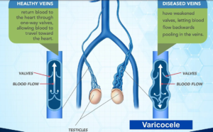 How Varicocele Impacts Fertility and What You Can Do About It?