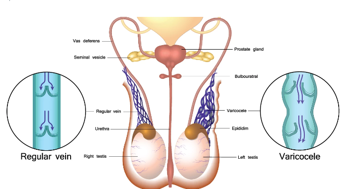 How Varicocele Impacts Fertility and What You Can Do About It?