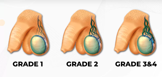 How Varicocele Impacts Fertility and What You Can Do About It?