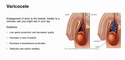 How Varicocele Impacts Fertility and What You Can Do About It?